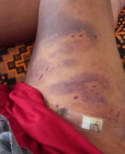 Capturar-2-245x300 Cuiabá: Jovem fica ferido após ser atacado por pitbull durante passeio com outro cão