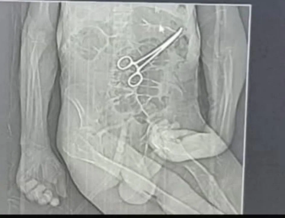 WhatsApp-Image-2025-12-30-at-19.40.35 Idoso morre após médicos esquecerem tesoura cirúrgica no abdômen durante procedimento em MG