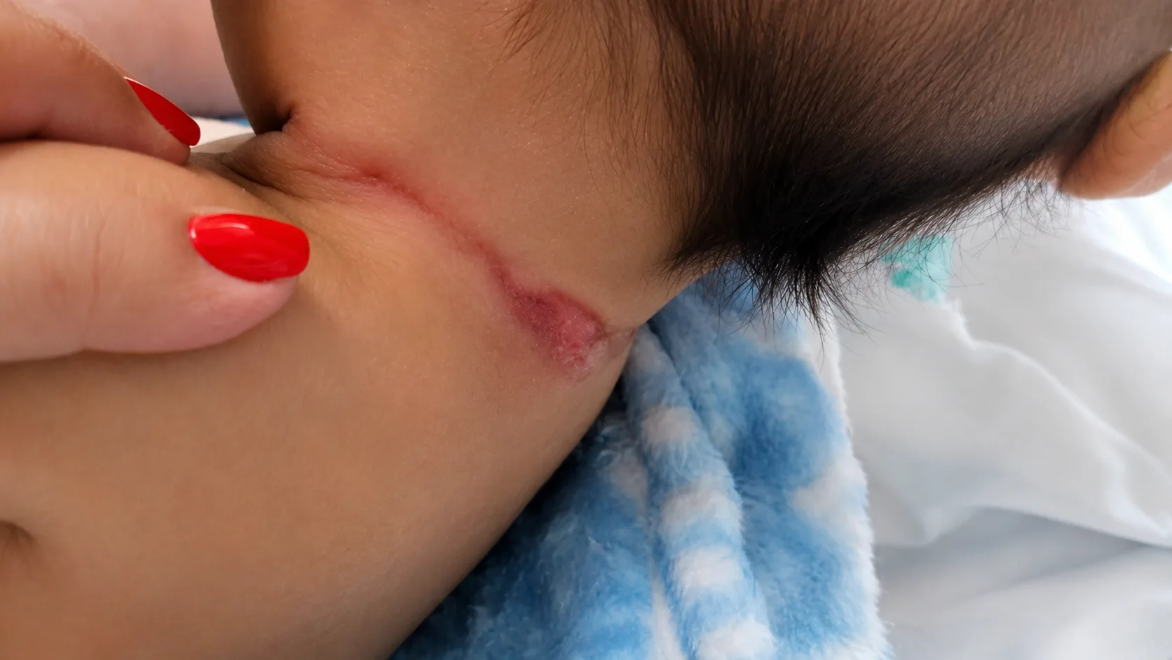 6a1f9457-488b-4635-8f20-afbc3bc4c4b6 Bebê de 2 meses morre após ser internado com lesões graves na cabeça e no pescoço