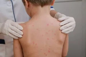images-26-300x200 Meningite viral em crianças leva cidade de MT a suspender aulas nas escolas